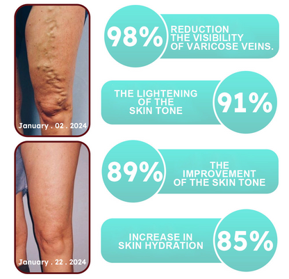 ✨ Last Day Discount: 80% OFF 🌸 JEREMYTIS™ Leech Varicose Veins Patch