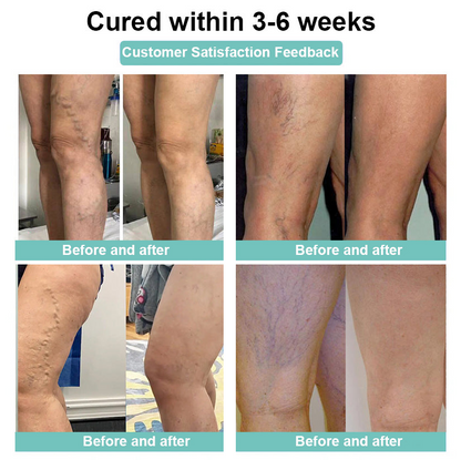 ✨ Last Day Discount: 80% OFF 🌸 JEREMYTIS™ Leech Varicose Veins Patch