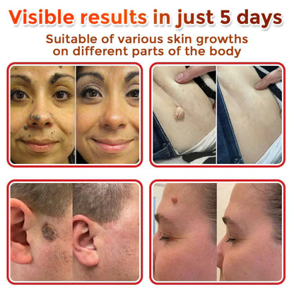 🌈 MicroNeedle Botanic Skin Tag Removal Patch (Made in the USA)