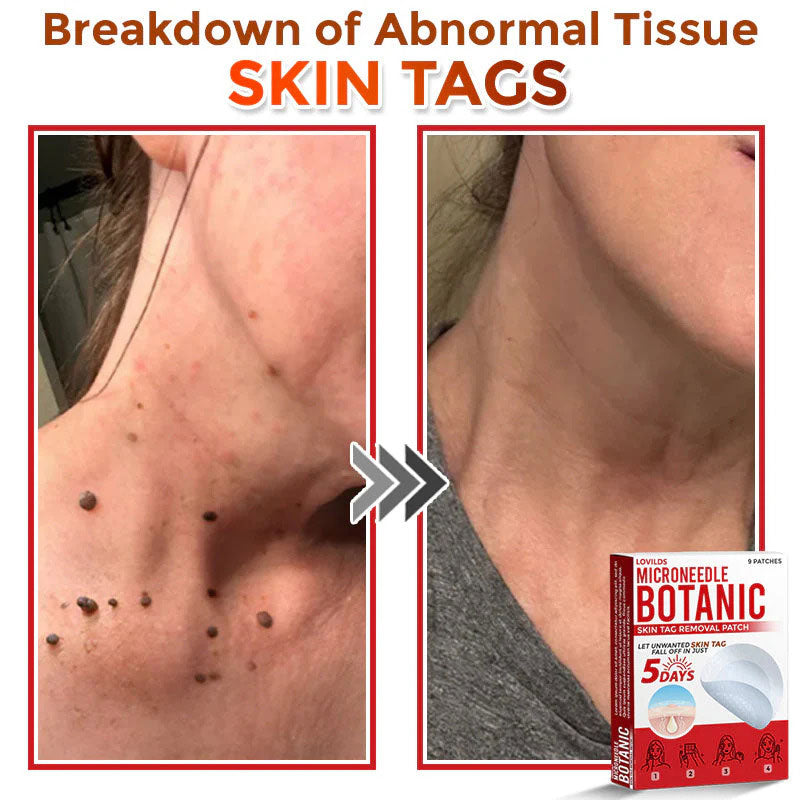 🌈 MicroNeedle Botanic Skin Tag Removal Patch (Made in the USA)