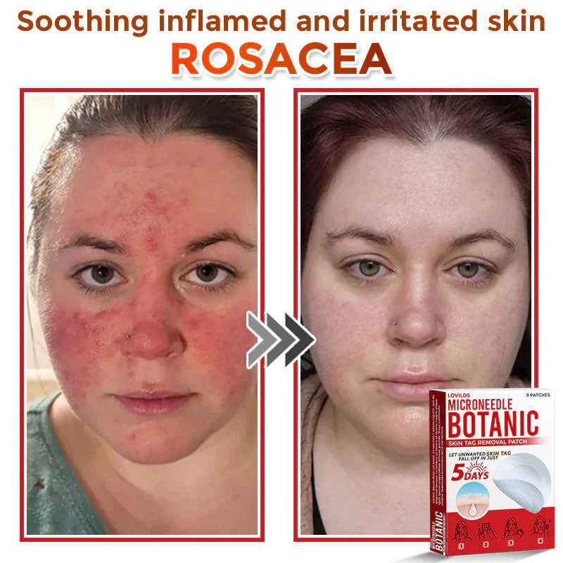 🌈 MicroNeedle Botanic Skin Tag Removal Patch (Made in the USA)