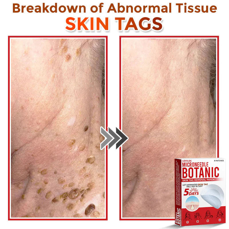 🌈 MicroNeedle Botanic Skin Tag Removal Patch (Made in the USA)