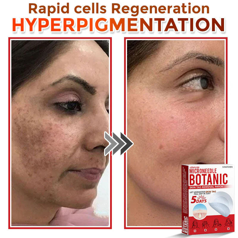 🌈 MicroNeedle Botanic Skin Tag Removal Patch (Made in the USA)