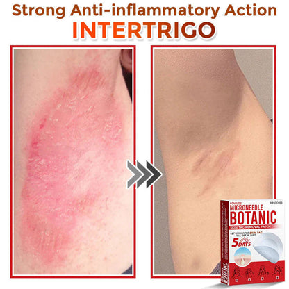 🌈 MicroNeedle Botanic Skin Tag Removal Patch (Made in the USA)
