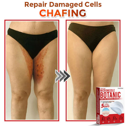 🌈 MicroNeedle Botanic Skin Tag Removal Patch (Made in the USA)