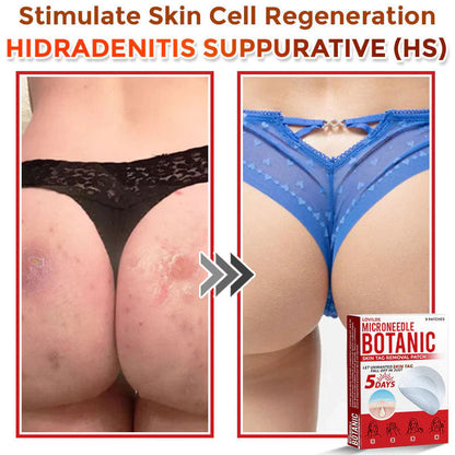 🌈 MicroNeedle Botanic Skin Tag Removal Patch (Made in the USA)