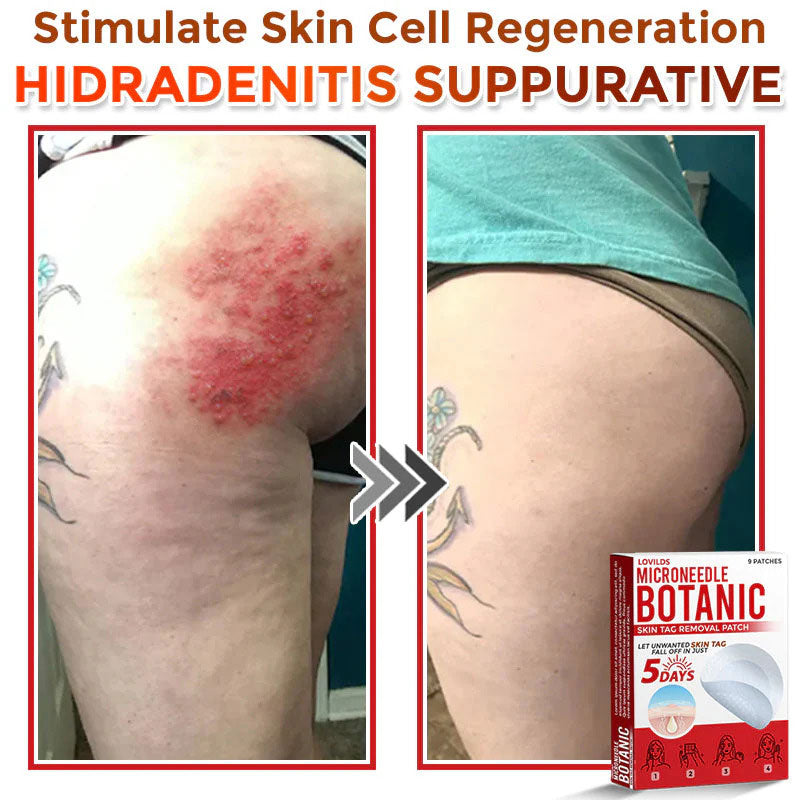 🌈 MicroNeedle Botanic Skin Tag Removal Patch (Made in the USA)