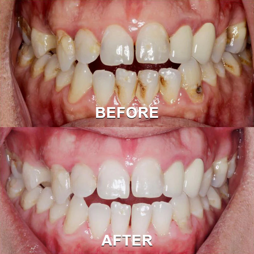 ✅Seurico™ Gum Repair & Oral Health Powder (CE Certified for Periodontitis, Mouth Sores, and Gum Recession)